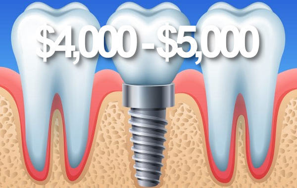 Price dental implants Perth